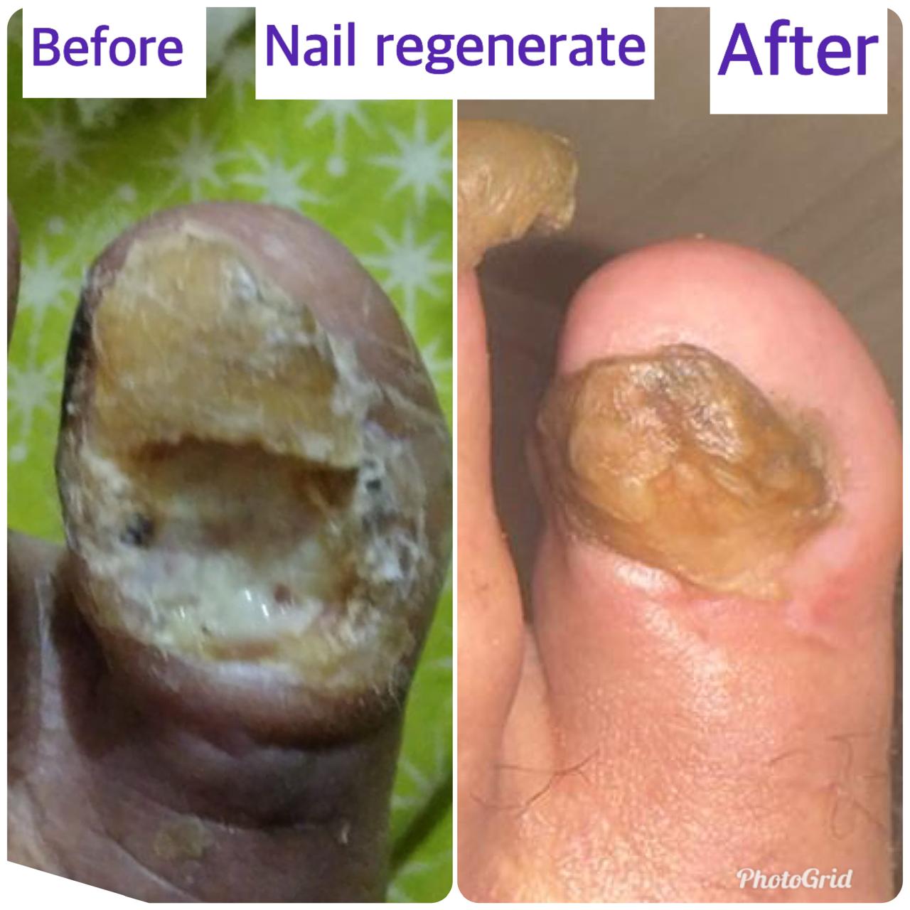 Nail regeneration after diabetic toe infection — before and after