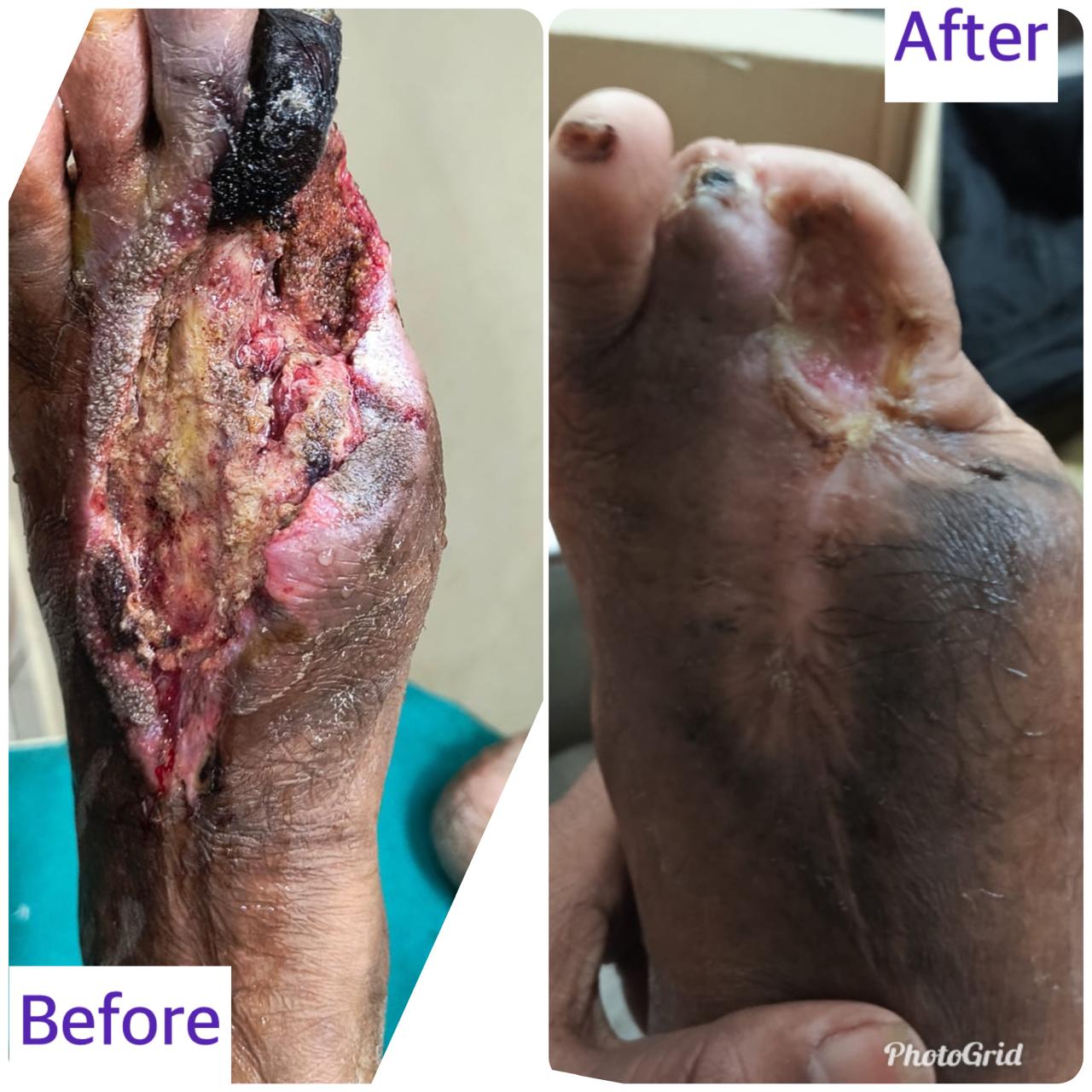 Extensive foot wound with gangrene — before and after treatment